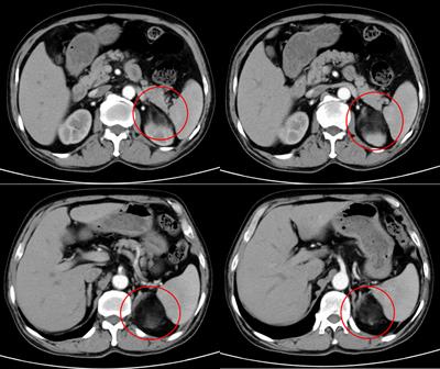 Case report: Adrenal myelolipoma resected by laparoscopic surgery